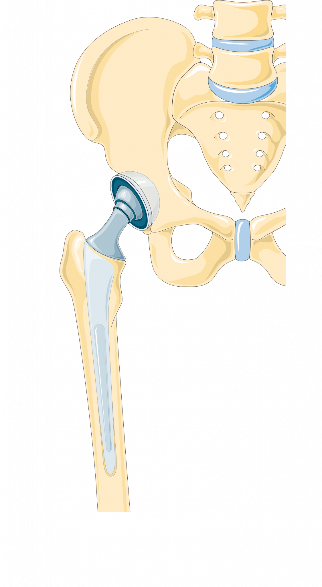 can-you-use-an-inversion-table-with-a-hip-replacement