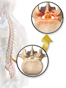 Can an Inversion Table Help With Spinal Stenosis