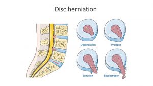 Disc Herniation