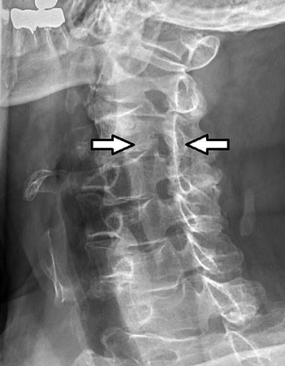 Radiograph Of Cervical Foraminal Stenosis Back Health 6461