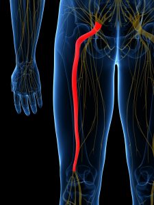 Illustration Of The Sciatic Nerve