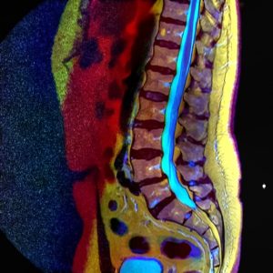 Spondylolisthesis