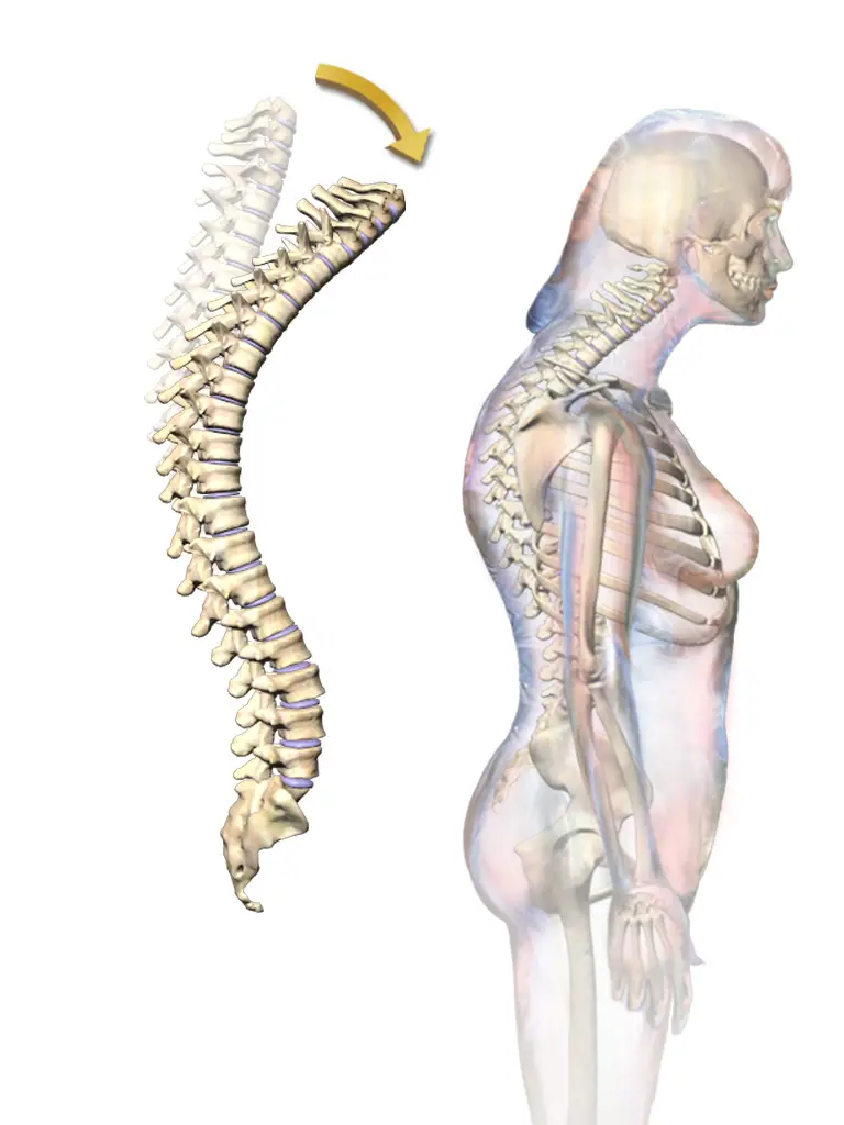 Can Inversion Table Help Kyphosis