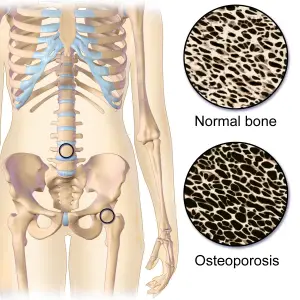 Osteoporosis Locations