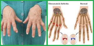 Rheumatoid Arthritis