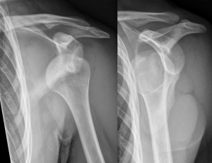 Can A Chiropractor Fix A Dislocated Shoulder