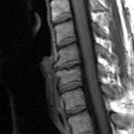 Can A Chiropractor Help With Degenerative Disc Disease