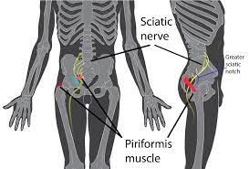 Can A Chiropractor Help With Piriformis Syndrome