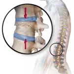 Can A Chiropractor Cause A Compression Fracture
