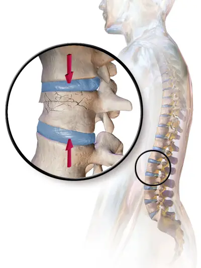 Can A Chiropractor Cause A Compression Fracture
