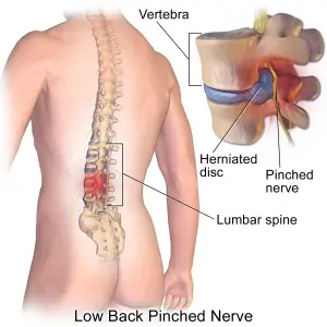 Can A Chiropractor Feel A Herniated Disc?