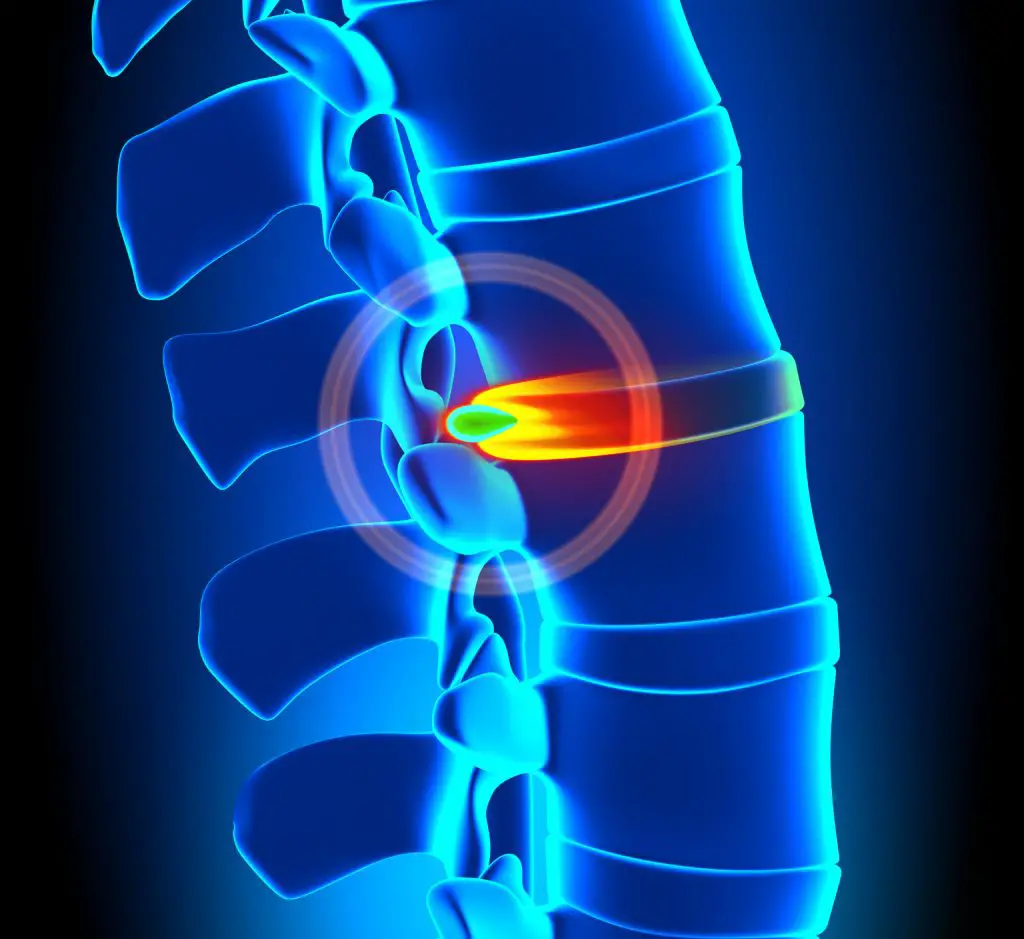 Can A Chiropractor Fix A Slipped Disc