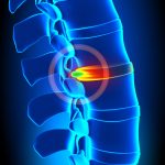 Can A Chiropractor Fix A Slipped Disc
