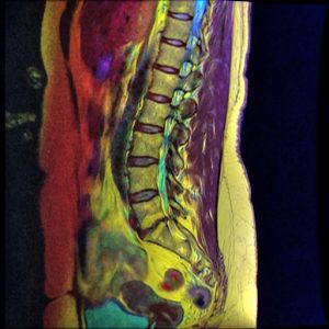 Can A Chiropractor Fix Retrolisthesis