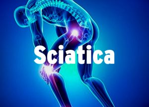 Can A Chiropractor Help With Sciatica Pain