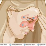 Can A Chiropractor Help With Sinus Issues