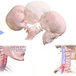 Can A Chiropractor Help With Whiplash