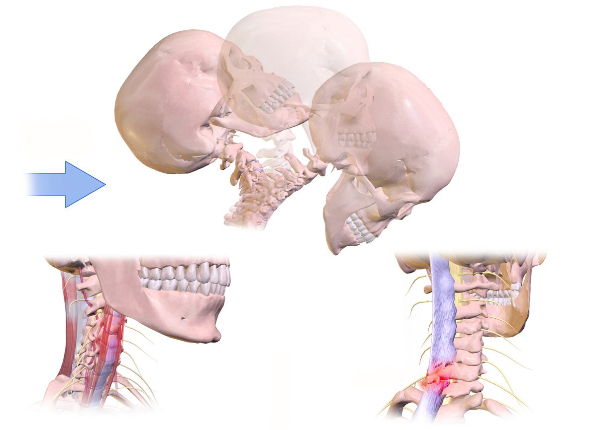 Can A Chiropractor Help With Whiplash
