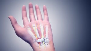 Can Chiropractic Care Help with Carpal Tunnel Syndrome