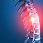 Can Scoliosis Cause Herniated Disc