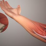 Can a Chiropractor Help With Tennis Elbow?