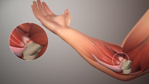 Can a Chiropractor Help With Tennis Elbow?