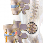 Can a Chiropractor Help a Herniated Disc