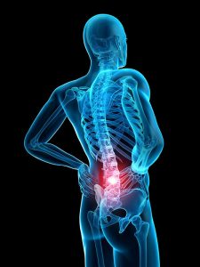 How Many Treatments for Sciatica with a Chiropractor