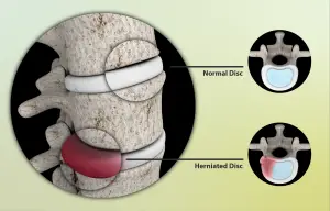Can A Chiropractor Identify A Herniated Disc